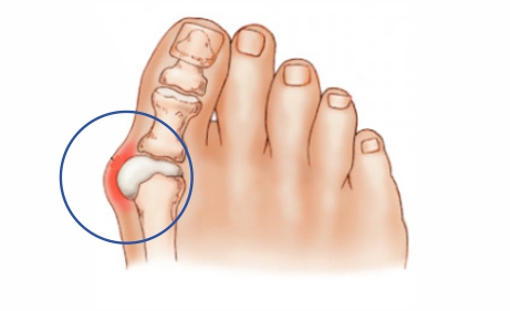 Признаки ушиба и перелома пальца ноги